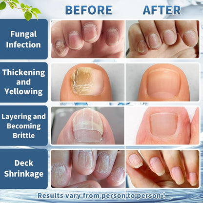 Maximum Strength Nail Fungi Treatment